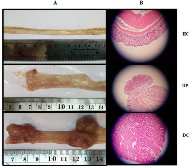 Effects of L. paracasei X12 on macroscopic appearance of tumor incidence, multiplicity and volume in colon of rats (A). Representative photomicrographs of histological (hematoxylin and eosin) cross-sections of colons tissue with magnification 40X from the treated and untreated rats (B). Normal colorectal tissues (HC group), colorectal adenoma (DP group) and colorectal adenocarcinoma (DC group). HC: healthy control group; DC: DMH alone group; DP: DMH induced rats treated by the L.paracasei X12