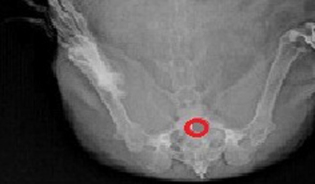 X-ray radiographic images of vaginal cavity at 8th h after administration of BaSO4-loaded optimized F3 Vaginal tablet in female rabbit