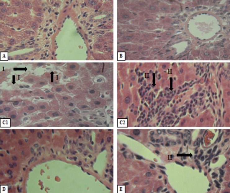 Histopathologicalevalution of liver sections. Formalin fixed liver sections of 5 μ thickness fromcontrol and diabetic were stained with H&E and images were taken at the magnification of 400X. Various panelsrepresent control (A), treated control (B), diabetic control (C1, C2), diabetic treated rats [D+Bb group](D) and diabetic treated rats [D+Ba group] (E).Total loss of hepatic architecture (I) and lymphocytic inflammation (II).