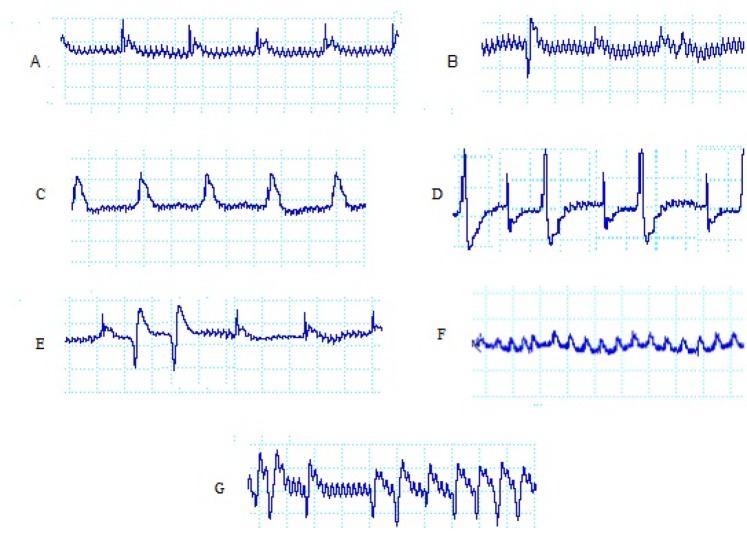Examples of electrocardiogram recordings and definition of various changes and arrhythmias: During baseline (A), single VEBs (B), ST segment during ischemia (C), by-geminate(D), couplet (E), ventricular fibrillation (F) and ventricular tachycardia (G)