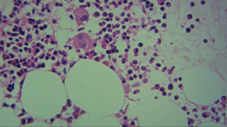 The bone marrow biopsy sample (*40) demonstrating partially normocellularity and presence of megakaryocytes