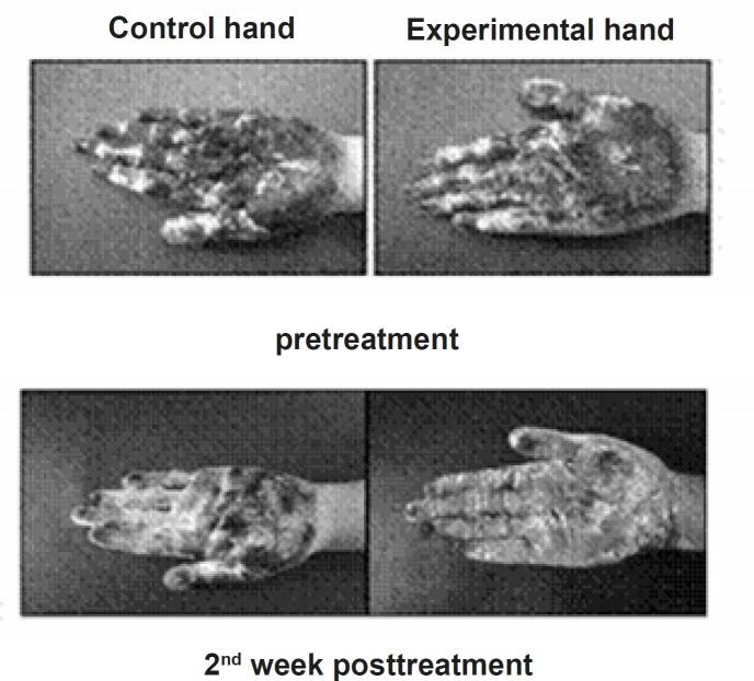 Iodine starch test of the experimental and control hand before and 2 weeks after the treatment.