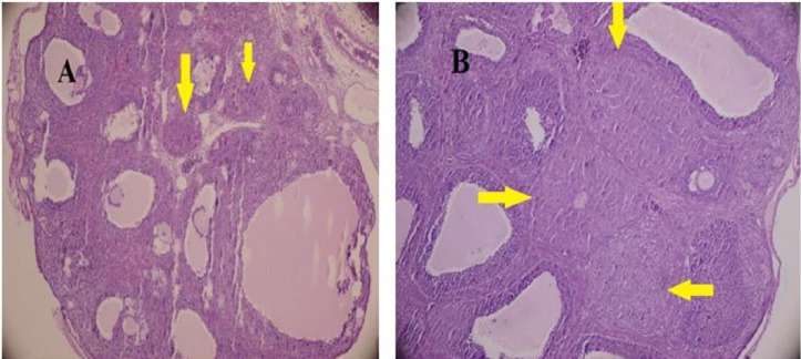 Histological feature of gonadotropin-induced rat ovaries after treatment with either DZN (A) or corn oil (control) (B ). The ovaries were collected at 24 h post-hCG injection and tissue sections were stained with hematoxylin and eosin. (H&E staining;× 400 ). The pointer shows CL. CL was smaller in diameter in DZN group, (diameter: control, 0.62 ± 0.08; DZN group, 0.31 ± 0.12 μm; P = 0.000