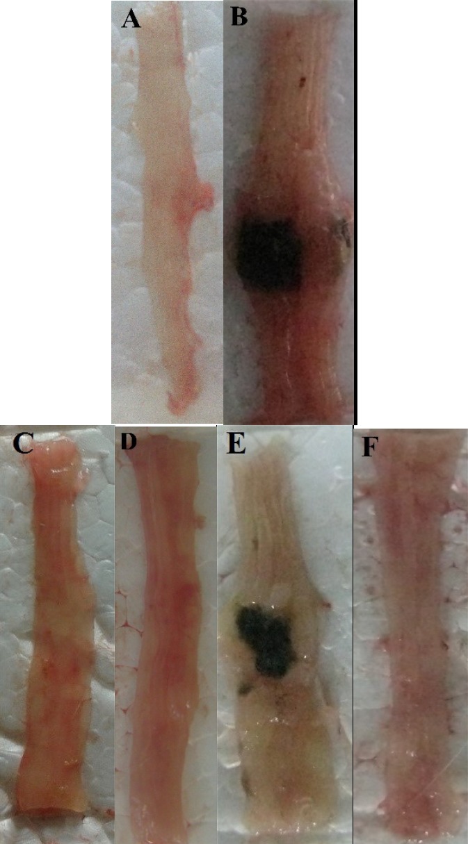 Photos of the distal colon appearance at day 5 after treatment of TNBS-induced colitis in mice. (A) Normal colon in Sham group; (B) Colitis control treated with normal saline; (C and D) Colitis treated with dizocilpine Dizocilpine has repeated and one of them should be deleted.(1 and 5 mg/kg, i.p.) (E) L-glutamic acid (2/kg, p.o.) and (F) dexamethasone (1 mg/kg, i.p.).