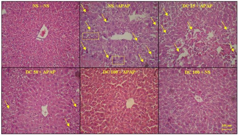 The liver sections regarding protective effects of doxycycline (DC) on hepatotoxicity of APAP in mice 3h after APAP. The animals were treated with DC 25, 50 and 100 mg/kg or normal saline (NS) just before APAP 400 mg/kg (H&E x300)