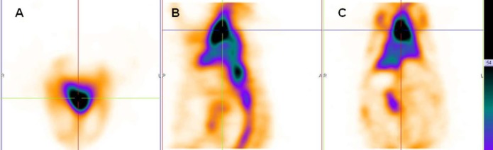 SPECT images of rabbit (A. transverse B. sagittal C. coronal) were obtained 15 minutes after injection of 99mTc-HMPAO-PEG-NLs (64 slices, 30 second/projection).