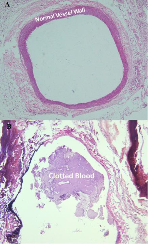 (A) Pathological examination of a cross section of the normal vein and (B) induced thrombosis in the rabbit’s IVC; thrombosis was induced by application of filtered FeCl3 solution stained Whatman No. 1 paper around the dissected IVC in-vivo
