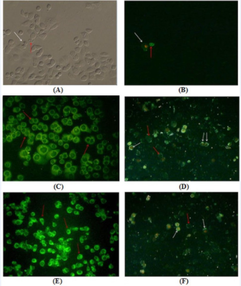 Annexin V–FLUOS and PI staining of AGS cells treated with F. angulata Boiss. leaf and flower extracts for 24 h. Early apoptotic cells with only Annexin V–FLUOS positive staining were recognized by green plasma membrane (red arrows), while late stage apoptotic cells with both Annexin V–FLUOS and PI positive staining were observed with green membrane and red nucleus (white arrows). A) and B) Untreated AGS cells observed under inverted microscope and fluorescence microscope, respectively. C) and D) AGS cells treated with 80 μg/mL and 160 μg/mL concentrations of F. angulata Boiss. leaf extracts, respectively. E) and F) AGS cells treated with 80 μg/mL and 160 μg/mL concentrations of F. angulata Boiss. flower extracts, respectively. Magnification 200X
