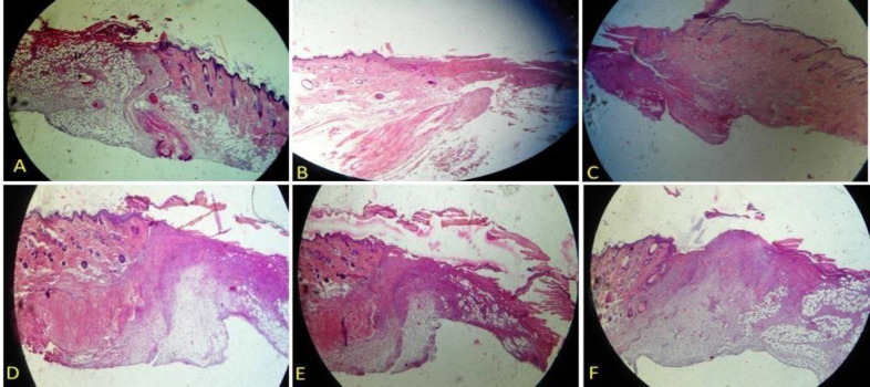 H&E staining of a wound area on days 3. A: Control, B: Control of diabetes, C: nanofiber-Chitosan/Polyvinyl alcohol, D: nanofiber-Chitosan/Polyvinyl alcohol/Doxycycline, and E: film-Chitosan/Polyvinyl alcohol, and F: film-Chitosan/Polyvinyl alcohol/Doxycycline (4X).