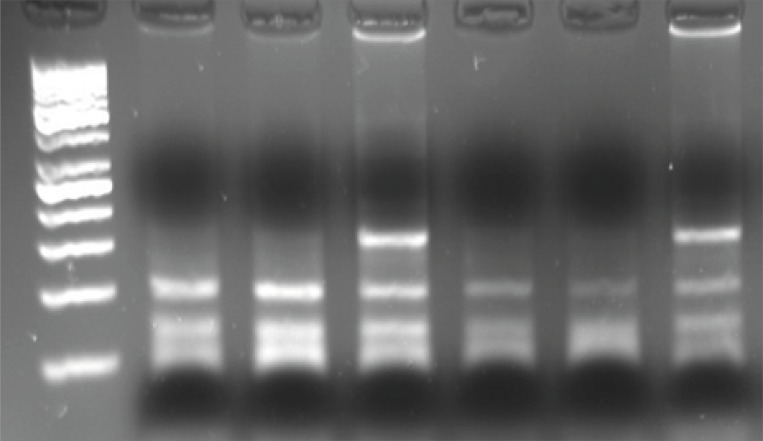 Identification of a polymorphism in amino acid 27 of beta2-adrenoceptor. Homozygotes for the glutamine 27 allele are in lanes 1, 2, 4 and 5. Gln/Glu heterozygotes are in lanes 3 and 6