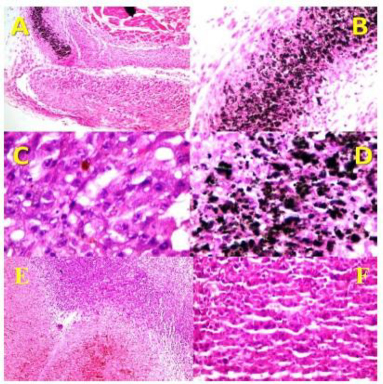 Histopathology of the skin of different groups. (A) It shows nodular melanoma associated with extensive necrosis in the CNT/Ag group (x40, H and E). (B and D) They show dense deposition of O-CNT/Ag-PEG1000 NPs in resolved area (B, x100, H&E) (D, x400, Hand E). (C) Areas of tumor residue next to resolved area with melanin pigment in the CNT/Ag group (x400, H and E). (E and F) They show nodular melanoma in the control group (E, x100, H and E) (F, x400, H and E).