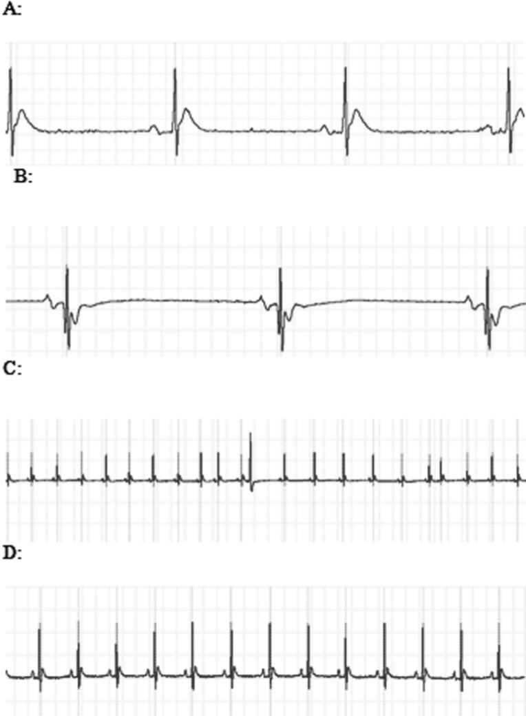A: The ECG showed ST segment elevation during exposure to 3000 PPM of CO. B: ST segment depression and T wave inversion after 1 h of re-oxygenation following the intoxication with 3000 PPM of CO. C: PVC and sick sinus syndrome (SSS) after intoxication with 3000 PPM of CO. D: Normal