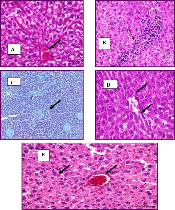 Liver treated with total flowers extract showing congested and marked dilation of hepatic sinusoids (H&E stain) (A), focal leucocytic aggregations within the portal area (H and E stain) (B) and multiple granulomas (Masson's trichrome stains) (C). Liver treated with root extract had mild degeneration (H&E stain) (D). Liver treated with drug had mild degeneration and congestion (H&E stain) (E).