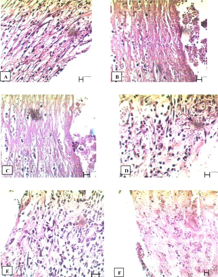Microscopic panel of wounds on the 14th day of treatment in rats. A) Control skin: The presence of invasive inflammatory cells is evident; no epithelial layer is seen. Vacuolization of the dermal cells, as well as adipose tissue substitution as indexes of immaturity, are evident. b) Tetracycline treated skin: Hemorrhage is relatively high. High density of fibroblasts and low density of blood capillaries are present around the wound. C) Alpha treated skin: Large numbers of blood capillaries are present in and around the wound. In some areas of the wound margins re-epithelialization can be seen. D) PHP 40% treated skin: Many blood capillaries exist in the wound; high density of fibroblasts is seen. E) PHP 10% treated skin: Re-epithelialization, high density of fibroblasts and blood capillaries are seen in the wound. F) Paste base treated skin: Fibroblasts are seen, but are less compared to the treated group; high density of inflammatory cells are present. PHP: poly herbal paste. ×400