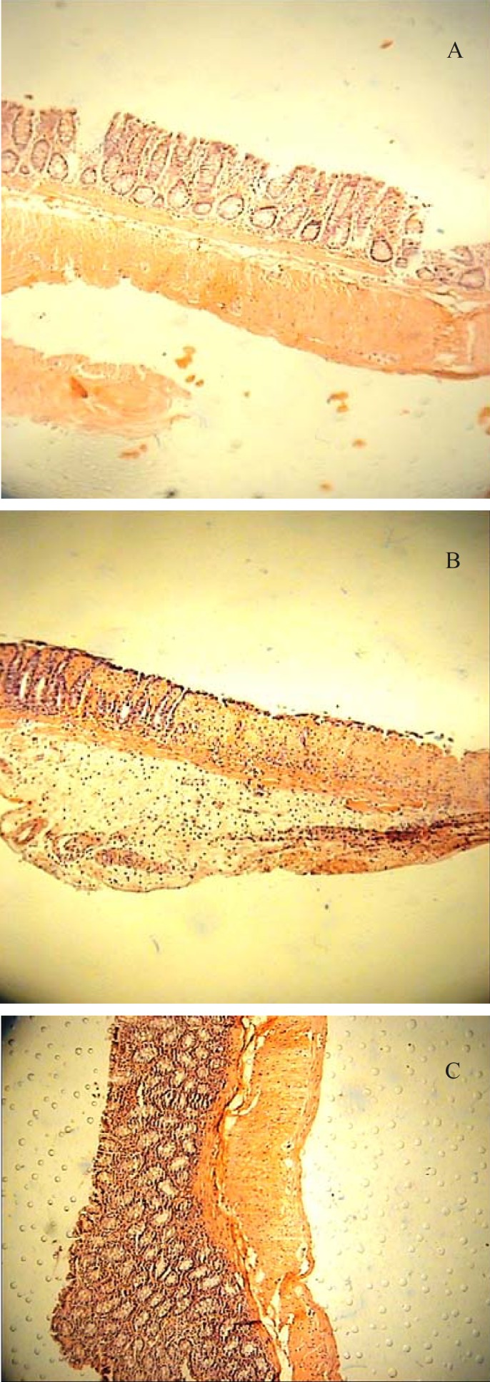 (A) Colitis induced by acetic acid in control rats. Erosion of surface epithelium, destruction of crypts and transmural hyperemia, edema and acute inflammation is evident (H&E section, low power). (B) Acetic acid-induced colitis treated with BFE (1500 mg/Kg); the mononuclear cell infiltrate of the lamina propria is much diminished but there is slight edema separating the crypts. All signs of acute inflammation have disappeared (H&E section, low power). (C) Acetic acid colitis treated with prednisolone (5 mg/Kg); the inflammation and crypt injury have been subsided significantly (H&E section, low power).