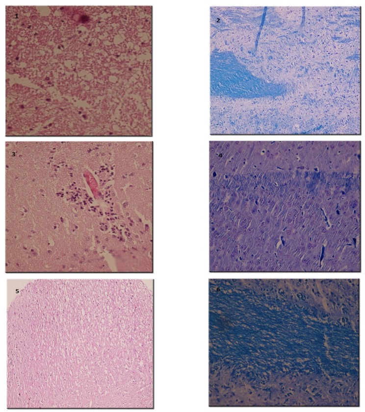 Histopathological evaluation of spinal cords by H&E and LFB. (1) Vacuolation and myelin degradation (H&E x 250). (2) Myelin degradation (LFB x 250). (3) Perivascular lymphocytic infiltration (H&E x 250). (4) Active myelin degradation with infiltration of macrophages. (H and E x 250). (5) Low power view of high-dose Ro 25-6981-treated mouse spinal cords with resolution of inflammation with no macrophage (H&E x 100). (6) Relatively normal myelin fibers after treatment with high-dose Ro 25-6981 (LFB x 250).