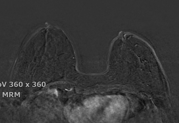 Axial T1-weighted fat-suppressed contrast-enhanced breast MR images showing minimal background parenchymal enhancement
