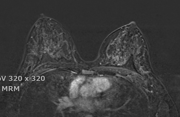 Axial T1-weighted fat-suppressed contrast-enhanced breast MR images showing moderate background parenchymal enhancement.