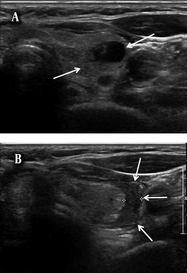 Comparison of cytological adequacy and pain scale score in  ultrasound-guided fine-needle aspiration of solid thyroid nodules for  liquid-based cytology with with 23- and 25-gauge needles: a single-center  prospective study