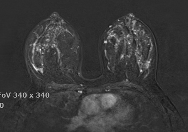 Axial T1-weighted fat-suppressed contrast-enhanced breast MR images showing marked background parenchymal enhancement