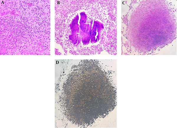 A, H&E stained sections show collection of histiocytes, foamy macrophages, abscess and B, sulfur granules highly suggestive of actinomyces bacterial colonies; C, gram stain.
