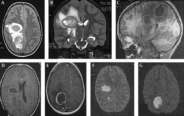 Cerebral MRI on a 12-year-old boy with two brain abscesses. A, Axial fluid-attenuated inversion recovery (FLAIR) weighted image shows two nodular frontal and parietal lesions with central high intensity and peripheral high intensity representing vasogenic oedema; B, Coronal T2-weighted image shows central hyperintensity with low intensity wall and peripheral vasogenic oedema; C, Sagittal T1-weighted image before administration of contrast material shows well-defined lesions with central low intensity and hyperintense wall; D and E, Axial contrast-enhanced T1-weighted MR images shows a regular thin-walled ring-enhanced lesions; F and G, Axial diffusion-weighted images shows marked hyperintensity in the abscesses.