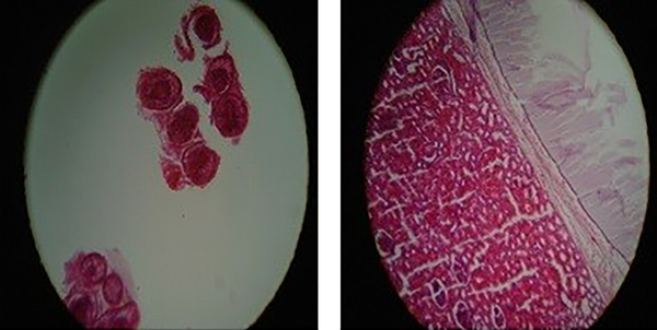Hydatid cyst of the kidney. Kidney tissue and a cyst with a chitinous layer on the right side of the picture are visible. Hematoxylin and Eosin stain, X10. Histopathological examination of surgically removed Scoleces (left slide). Hematoxylin and Eosin stain, X40