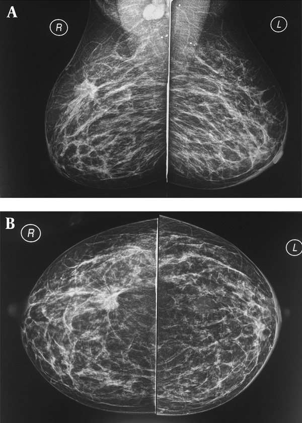 A and B, A 37-year-old breastfeeding woman 9 months postpartum presented with a growing tender mass in the upper outer area of right breast, on the obtained CC and MLO view mammographic images in right upper outer quadrant there is a spiculated irregular shaped mass causing tissue distortion associated with right axillary lymphadenopathy, metastasis to left axillary lymph nodes causing left areolar thickening; final histologic report revealed invasive ductal carcinoma.