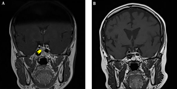 Pituitary MRI before (A) and five months after (B) the second TSS. A, MRI of the pituitary at presentation revealed a right pituitary microadenoma measuring 1.7 mm × 1.3 mm (yellow arrow head). B, MRI of the pituitary five months after TSS showed no evidence of tumour recurrence.
