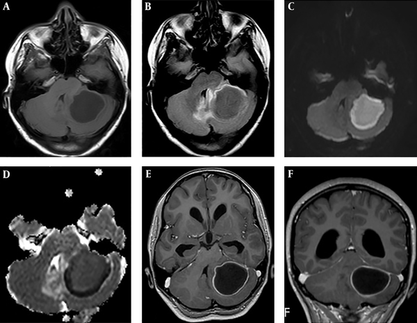 Cerebral MRI in a 10-year-old girl with brain abscess. A, Axial T1-weighted image before administration of contrast material shows well-defined lesion in the left cerebellum with central low intensity and isointense wall; B, Axial fluid-attenuated inversion recovery (FLAIR) weighted image shows central high intensity with peripheral high intensity (vasogenic oedema); C, Axial diffusio-weighted image shows marked hyperintensity in the abscess; D, ADC map reveals slight hypointensity, representing restricted diffusion in the corresponding region; E and F, Axial and coronal contrast-enhanced T1-weighted MR images shows a regular thin-walled ring-enhanced lesion.
