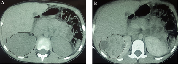 A, Precontrast CT scan shows decreased density and enlargement of right kidney; B, Gerota’s fascia thickening is evident; C: Contrast enhanced CT scan in nephrogram phase showing a heterogeneous ill-defined mass with some cystic components and perinephric extension.