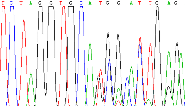 Sanger Sequencing Result of Identified Variant in the Parents in Heterozygous Form