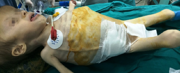 Image of the patient after the operation