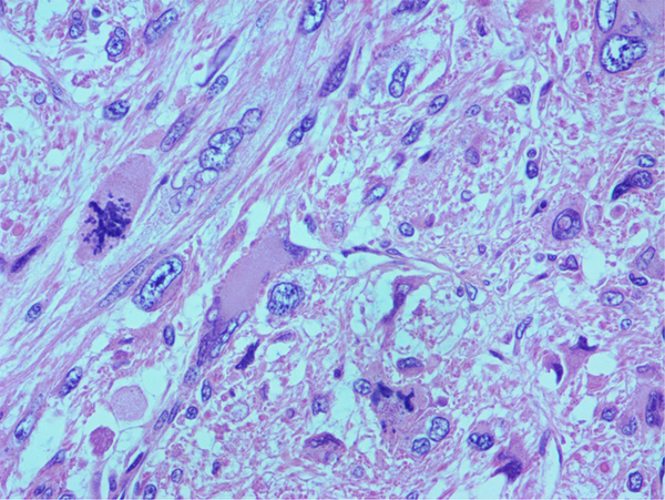Pathological Hematoxylin and Eosin Staining of the Tumor Tissue of the Resected Primary Leiomyosarcoma of Proximal Humerus