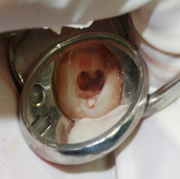 The appearance of access cavity
