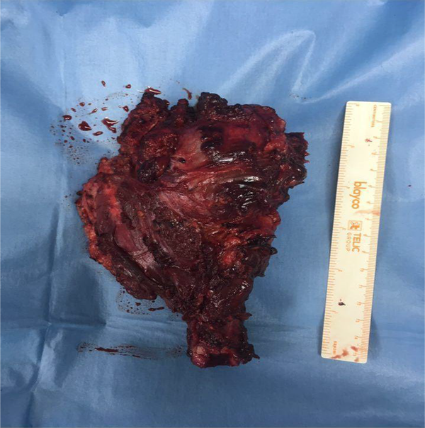 The Resected Tumor Attached to Humorous Head and Neck