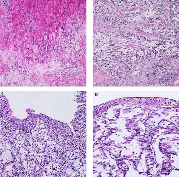 A, bladder mucosa infiltrated by a mucinous adenocarcinoma, H & E (×100). B, another view of the tumor showing obvious glandular differentiation with signet ring cells (×100). C, invasion of the tumor through muscularis propria into bladder adventitia (×40). D, PAS staining demonstrating intra and extra cellular mucin produced by the tumor (×40).