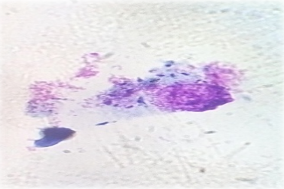 Microscopic image of mouse peritoneal macrophage infected with L. major amastigotes in vitro and stained with Giemsa reagent, viewed under oil immersion (magnification × 1000). The arrows show amastigotes-infected macrophage.