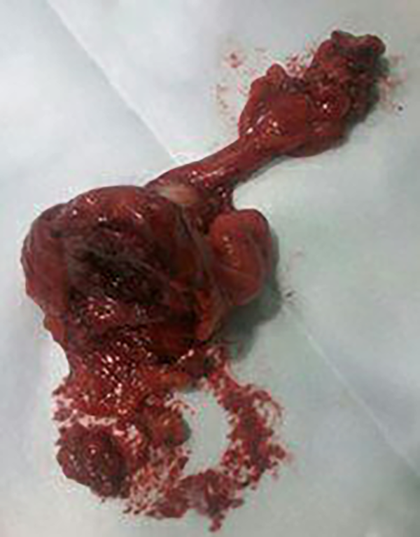 Tumor removed en bloc together with the umbilicus, lateral umbilical ligaments, adjacent peritoneum and bladder dome.