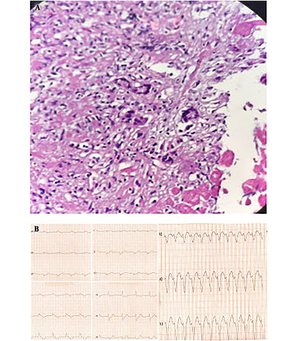 A, Histopathologic view of myocardial sample showed multiple giant cells, severe inflammation and necrosis; B, A-V block and VT respectively.
