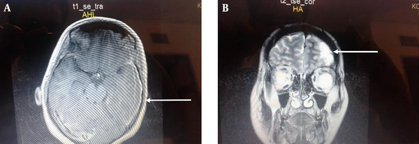 A, The Brain MRI without gadolinium T1 axial view showing a homogenous well-differentiated subdural collection in the left parietal lobe. B, Brain MRI with gadolinium T2 coronal view showing a well-differentiated subdural collection enhanced with gadolinium in the left parietal-frontal lobe without midline shifting.