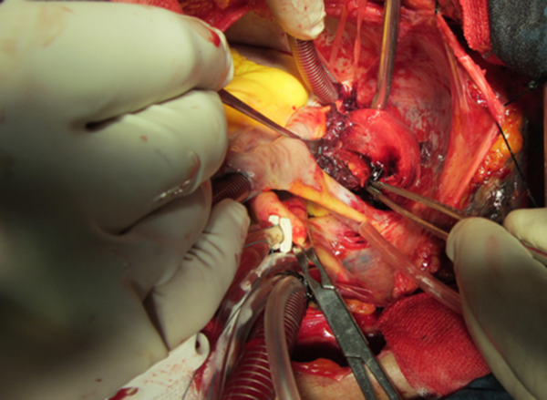 Shows Intra Operative View of Pericardial Cyst