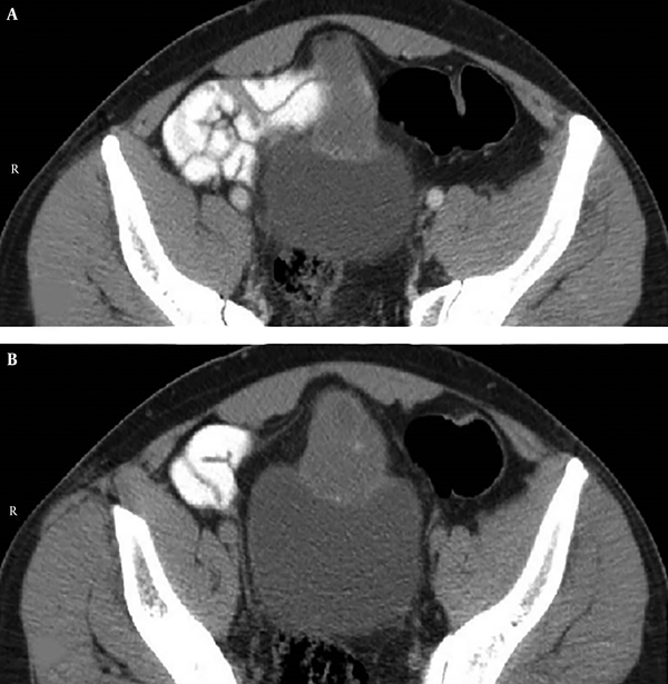 Axial image, contrast-enhanced CT scan of pelvis in the portal venous phase demonstrates heterogeneously enhancing mass lesion adjacent to bladder dome extending to umbilicus.