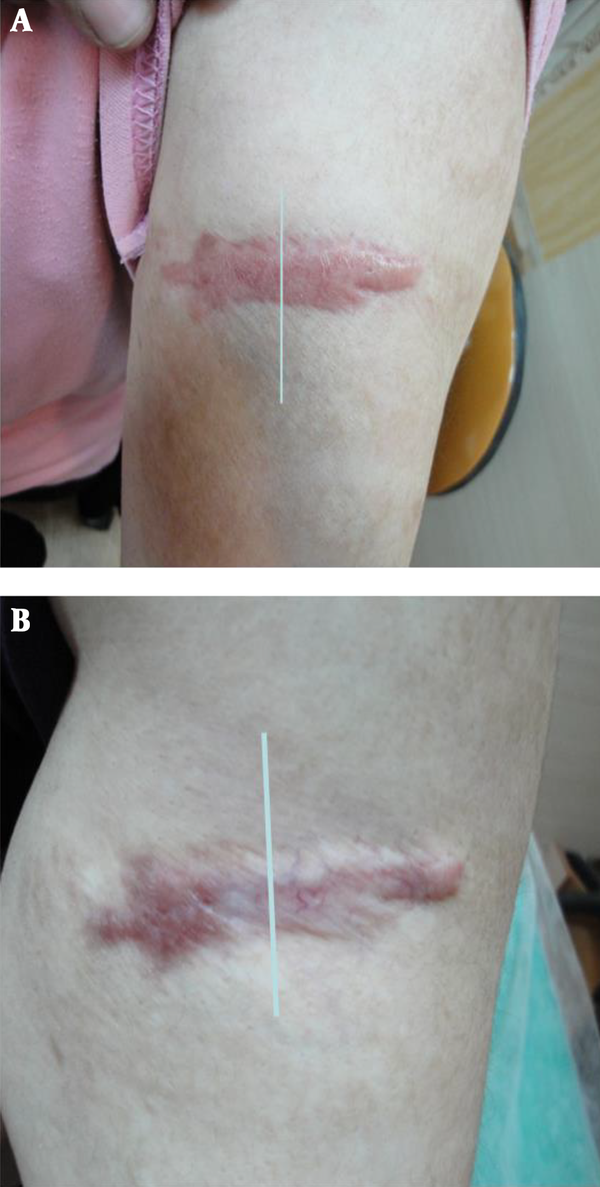 A, before treatment; B, after treatment.