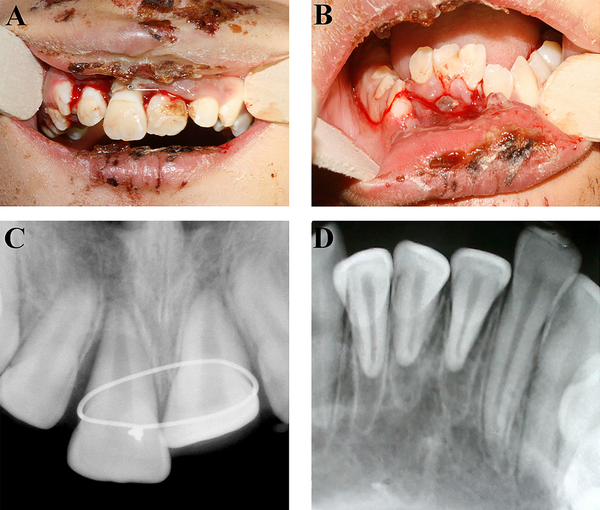 Clinical and radiographic appearance of maxillary and mandibular incisors two days after injury