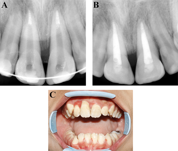 A, B, Endodontic treatment of the maxillary central incisors; C, The splints were removed after 6 weeks.