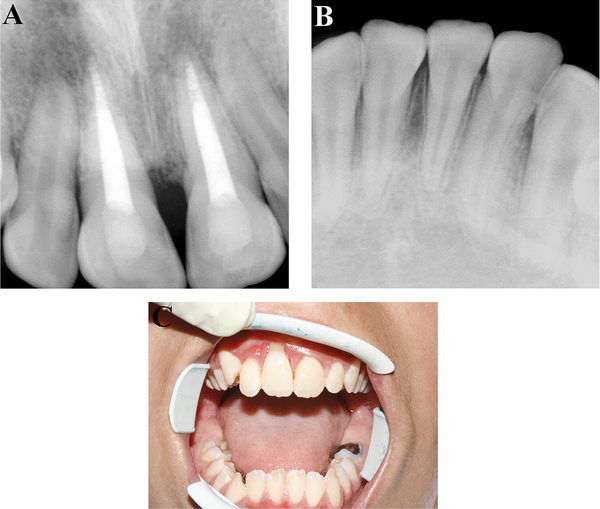 Radiographic (A, B) and Clinical (C) appearance at 18 months follow-up; Normal color of the crowns and normal position of the teeth is seen.