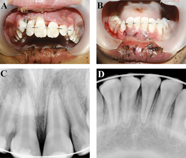 A, B, Clinical appearance of wire-composite splinting of maxillary and mandibular incisors; C, D, Radiography was taken to ensure correct positioning of the teeth, The splint was extended to the primary canines.