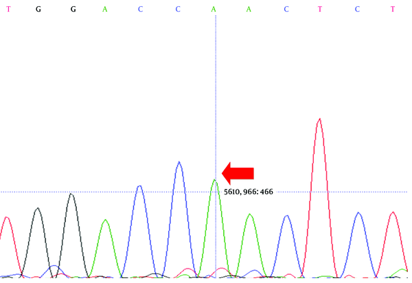 The result of genetic sequencing, indicating the homozygous missense mutation in exon 10 of the patient’s LDLR gene (sequencing with forward primer)