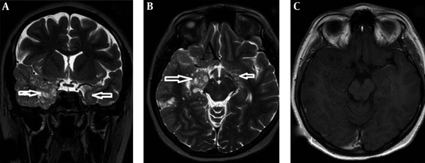 The MRI, T2-weighted, axial and coronal showed multiple nonspecific hyperintense lesions in the bilateral temporal lobe in white and gray matter associated with mesial temporal sclerosis (A and B). Axial T1C+ image shows no significant enhancement of the tumor in the temporal lobe (C).